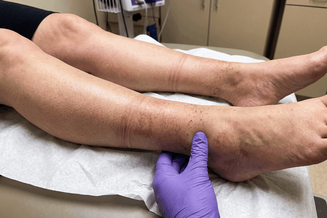 A gloved finger pressing into a swollen lower leg on an exam table, then the dent it leaves behind in the skin.
