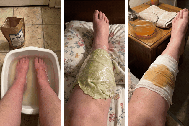 Six home remedies in two sets of three, each with a red X: feet soaking in a basin next to a bag of Epsom salt, a leg wrapped in a cabbage leaf and a leg wrapped in a vinegar-soaked cloth; then lotion rubbed up a red leg, an ice pack across both shins in bed and a mug of dandelion tea on a bathroom counter.