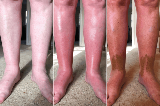 Three close-ups of the same legs over time: pale and puffy, then red and swollen, then red with a rust-brown band around the ankles and lower shins, with red arrows from one to the next.